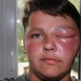 Ubod pčele - kako ublažiti otok